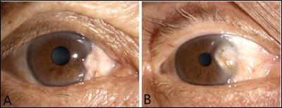 Application of artificial intelligence models for detecting the pterygium that requires surgical treatment based on anterior segment images